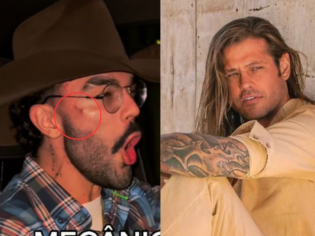 Imagem de Cantor aparece com hematomas após suposta briga com Dado Dollabela